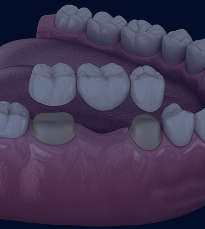 Treatment - Chase Side Dental