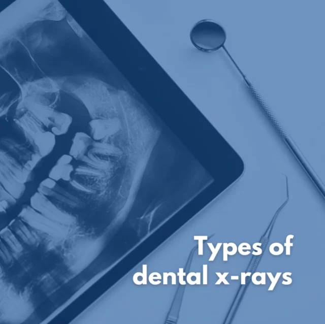 Ever wondered how dentists see beyond the surface? 🔍 Here are the main types of dental X-rays used:

📌 Bitewing X-rays – Used to capture detailed images of the upper and lower back teeth on both sides.
📌 Periapical X-rays – Provides a complete view of a single tooth, from crown to root.
📌OPG (Orthopantomogram) – A full-mouth panoramic X-ray that displays all teeth, jawbones and sinuses, commonly used for orthodontics and wisdom teeth assessment.
📌CBCT (Cone Beam CT) Scan – A 3D scan of your teeth, jaw, and soft tissues, used for precise diagnosis in implant planning and root canals.

X-rays are a valuable tool to ensure your smile's longevity. Contact us now to arrange your next dental examination! 🦷💙

#DentalXrays #OralHealth #HealthySmile